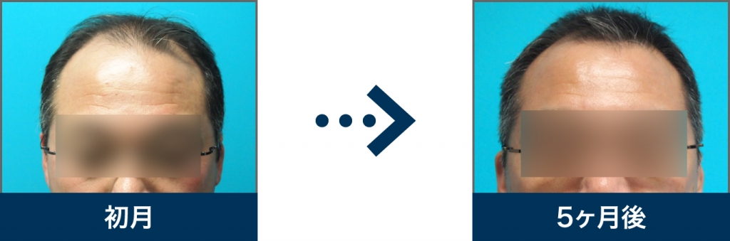 Ⅵ型 52歳 男性 治療5ヶ月