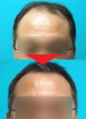 52歳男性｜発毛実績｜薄毛治療のドクターグロー