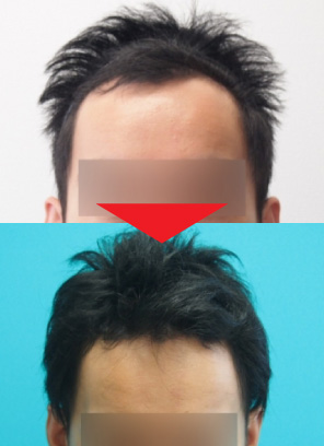 32歳男性｜発毛実績｜薄毛治療のドクターグロー