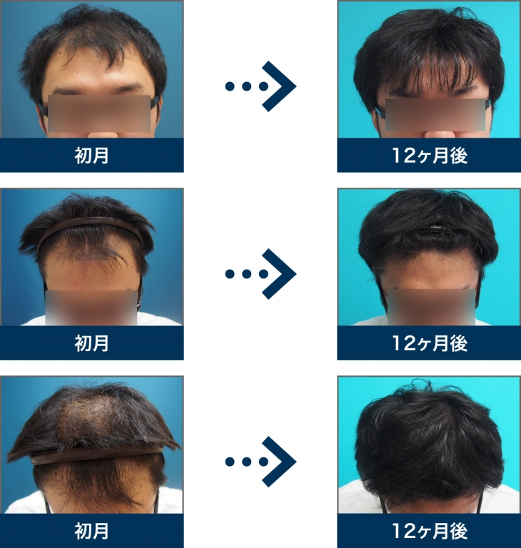 Ⅴ型 21歳 男性 治療12ヶ月