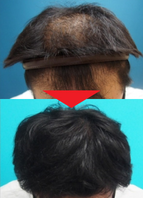 21歳男性｜発毛実績｜薄毛治療のドクターグロー