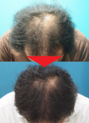 34歳男性｜発毛実績｜薄毛治療のドクターグロー