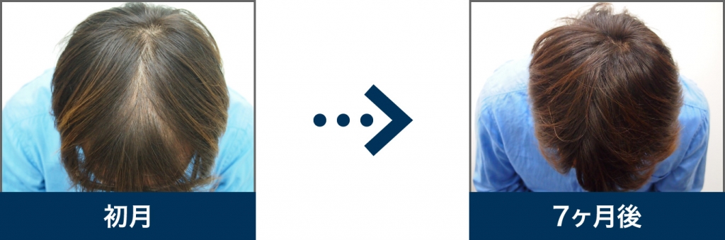 Ⅲ型 33歳 男性 治療7ヶ月