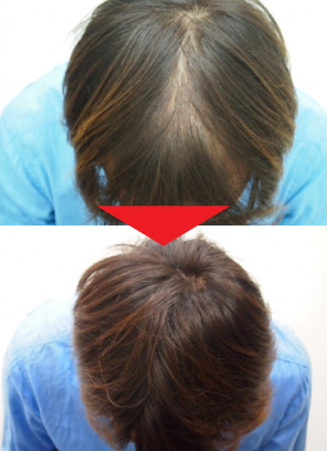 33歳男性｜発毛実績｜薄毛治療のドクターグロー