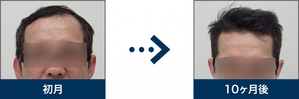 Ⅳ型 47歳 男性 治療10ヶ月