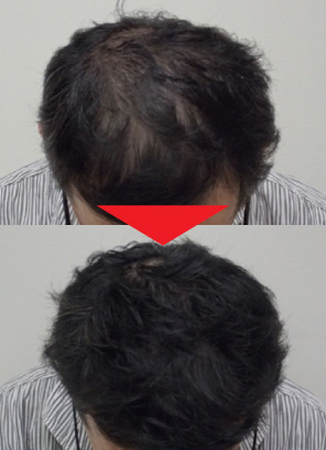 47歳男性｜発毛実績｜薄毛治療のドクターグロー