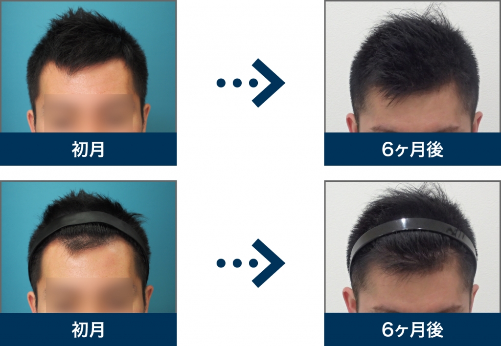 Ⅱ型 29歳 男性 治療6ヶ月