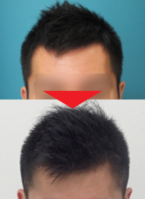 29歳男性｜発毛実績｜薄毛治療のドクターグロー