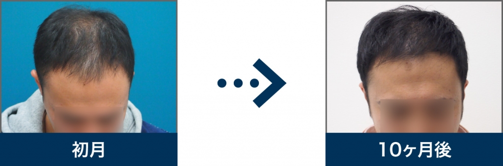 Ⅳ型 28歳 男性 治療10ヶ月