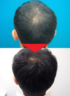 28歳男性｜発毛実績｜薄毛治療のドクターグロー