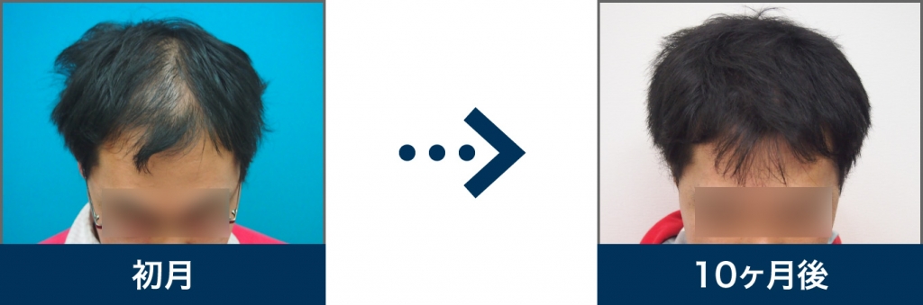 Ⅴ型 29歳 男性 治療10ヶ月