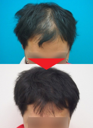 29歳男性｜発毛実績｜薄毛治療のドクターグロー