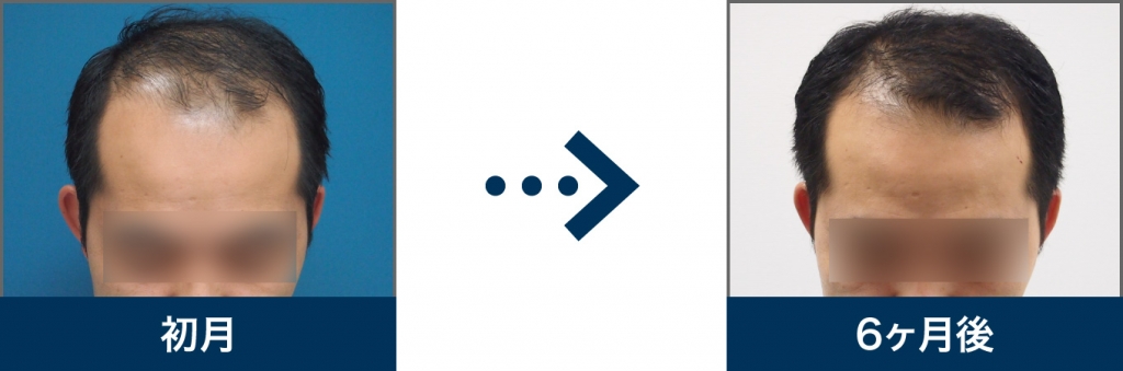 Ⅵ型 35歳 男性 治療6ヶ月