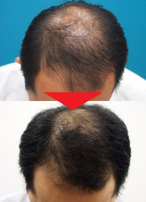 35歳男性｜発毛実績｜薄毛治療のドクターグロー