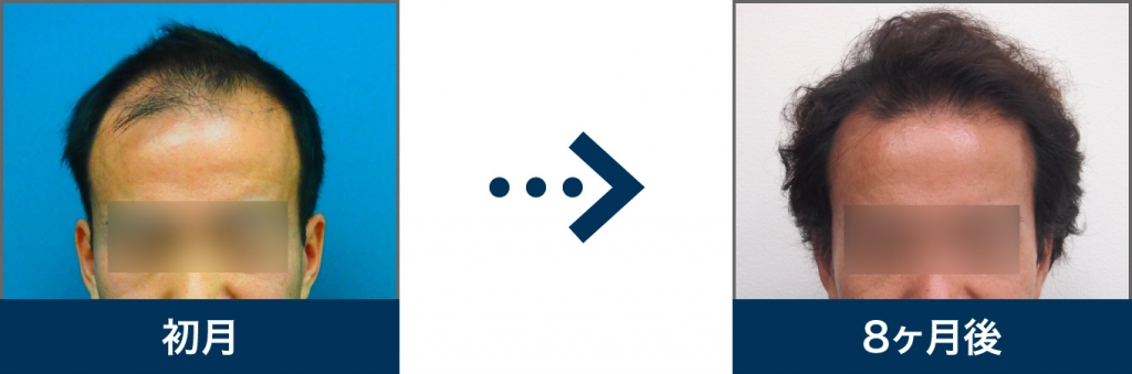 Ⅴ型 42歳 男性 治療8ヶ月