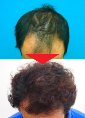 42歳男性｜発毛実績｜薄毛治療のドクターグロー