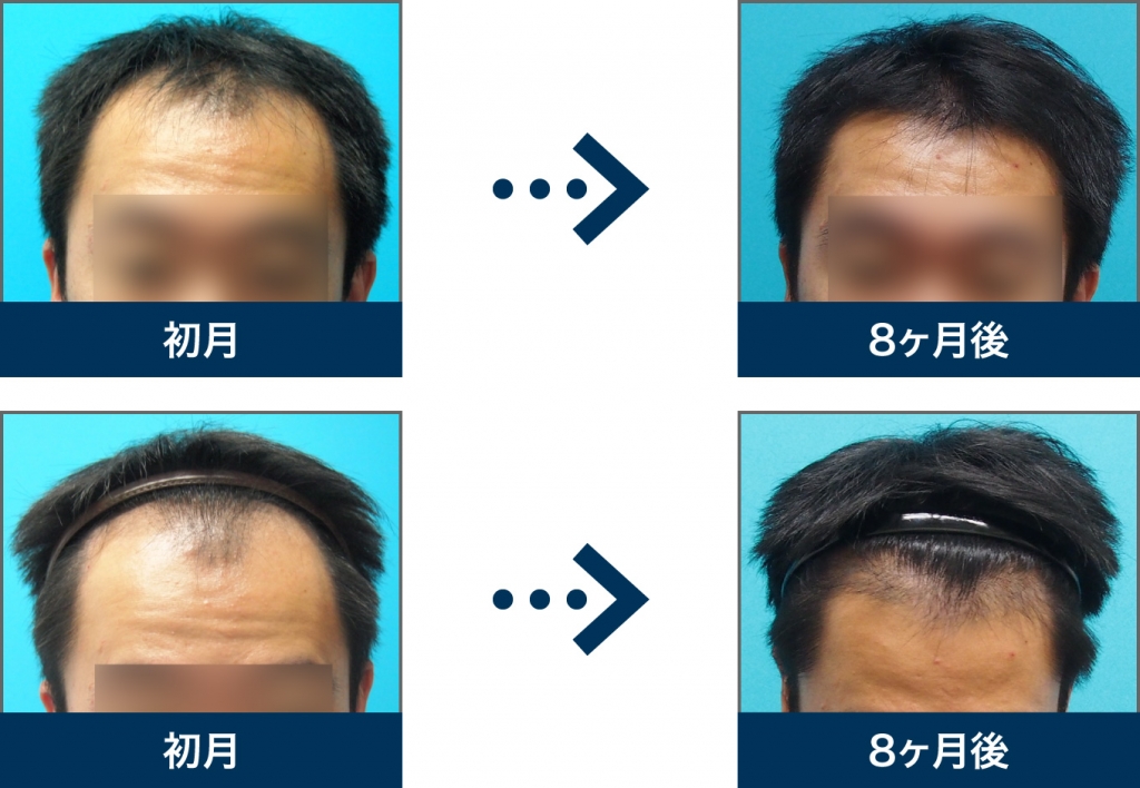 Ⅲ型 30歳 男性 治療8ヶ月