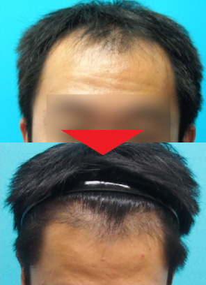 30歳男性｜発毛実績｜薄毛治療のドクターグロー