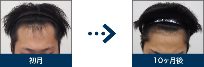 Ⅲ型 22歳 男性 治療10ヶ月