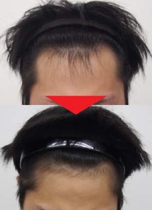 22歳男性｜発毛実績｜薄毛治療のドクターグロー