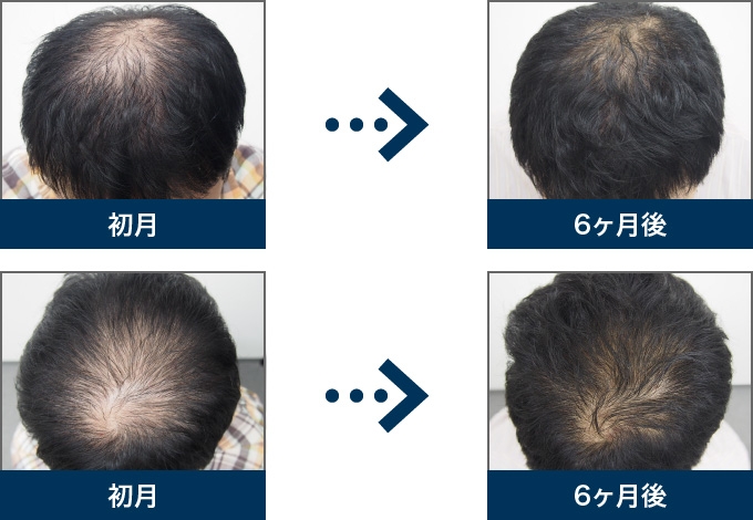 Ⅱ型 28歳 男性 治療6ヶ月