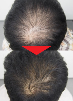 28歳男性｜発毛実績｜薄毛治療のドクターグロー