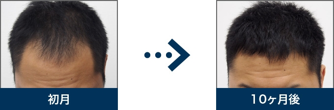 Ⅲ型 29歳 男性 治療10ヶ月