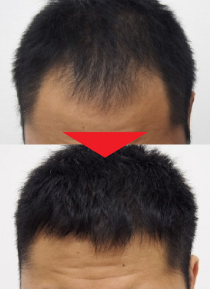 29歳男性｜発毛実績｜薄毛治療のドクターグロー