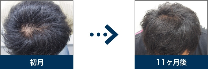 Ⅳ型 30歳 男性 治療11ヶ月