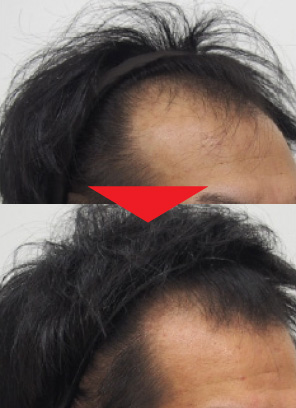 30歳男性｜発毛実績｜薄毛治療のドクターグロー