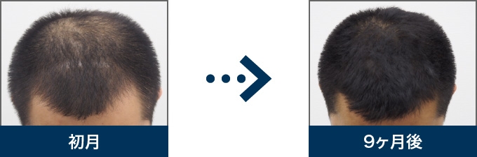 Ⅱ型 35歳 男性 治療9ヶ月