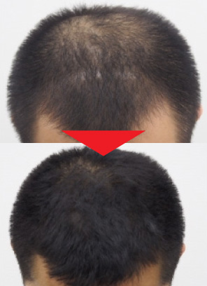 35歳男性｜発毛実績｜薄毛治療のドクターグロー