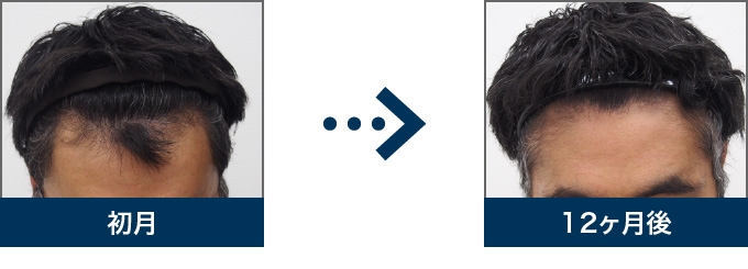 Ⅲ型 38歳 男性 治療12ヶ月