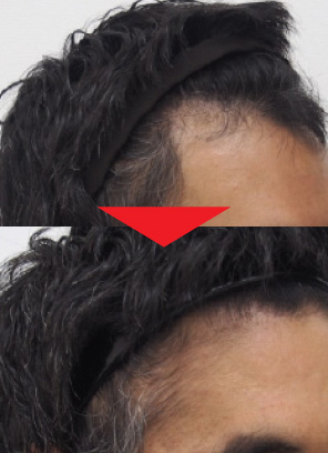 38歳男性｜発毛実績｜薄毛治療のドクターグロー