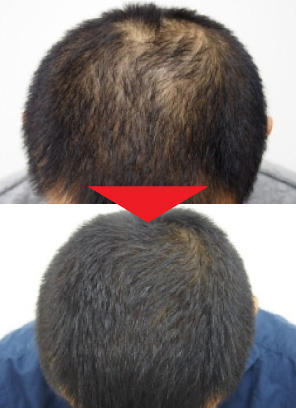 42歳男性｜発毛実績｜薄毛治療のドクターグロー