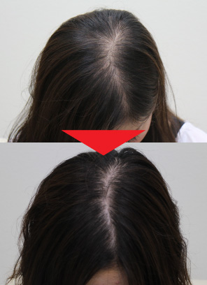 22歳女性｜発毛実績｜薄毛治療のドクターグロー