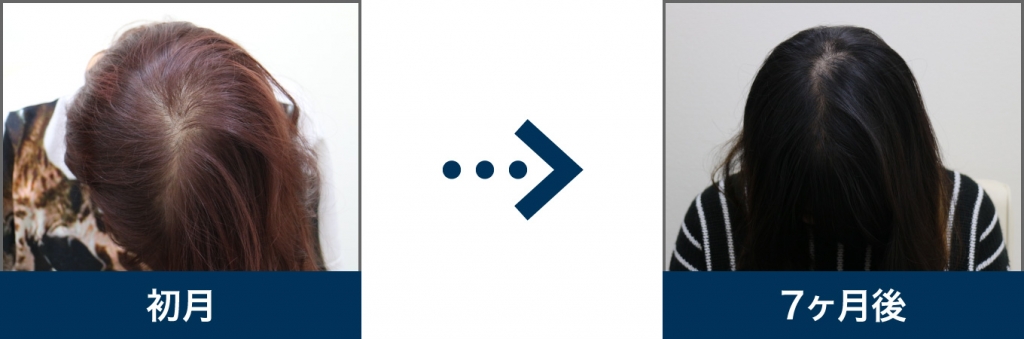 23歳 女性 治療7ヶ月