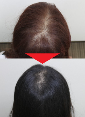 23歳女性｜発毛実績｜薄毛治療のドクターグロー