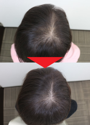 25歳女性｜発毛実績｜薄毛治療のドクターグロー