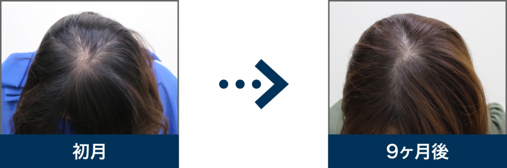 30歳 女性 治療9ヶ月