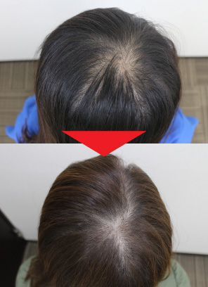 30歳女性｜発毛実績｜薄毛治療のドクターグロー