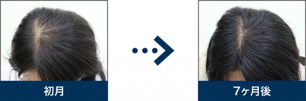 33歳 女性 治療7ヶ月