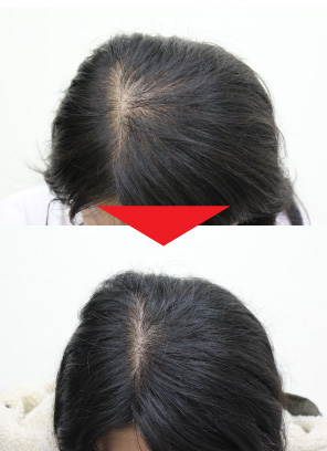 33歳女性｜発毛実績｜薄毛治療のドクターグロー