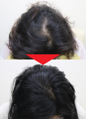 34歳女性｜発毛実績｜薄毛治療のドクターグロー