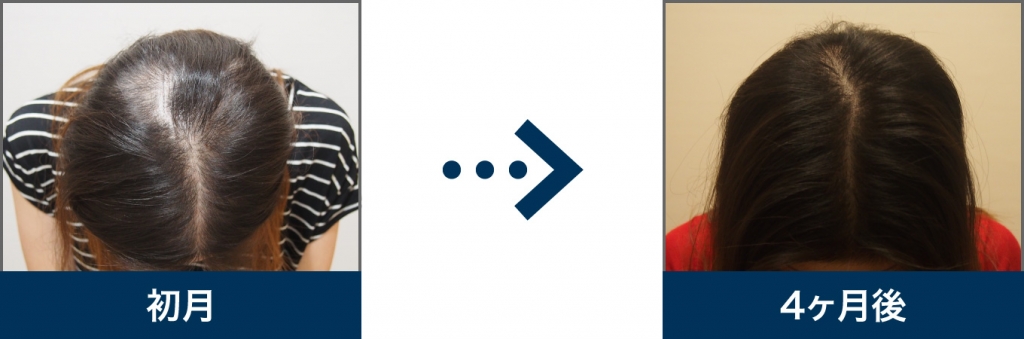 36歳 女性 治療4ヶ月