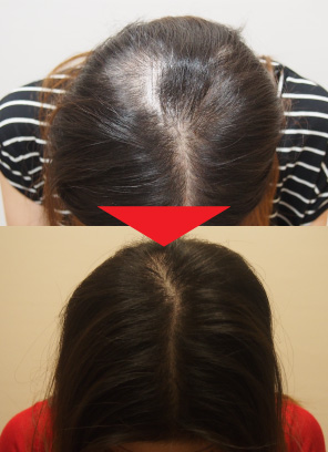 36歳女性｜発毛実績｜薄毛治療のドクターグロー