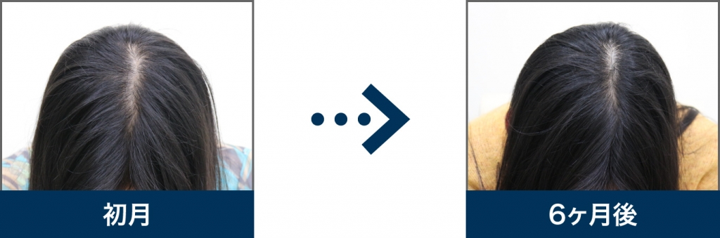 41歳 女性 治療6ヶ月