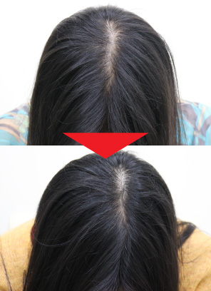 41歳女性｜発毛実績｜薄毛治療のドクターグロー