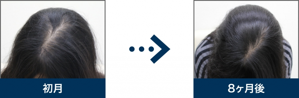 43歳 女性 治療8ヶ月