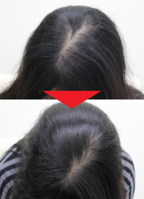 43歳女性｜発毛実績｜薄毛治療のドクターグロー